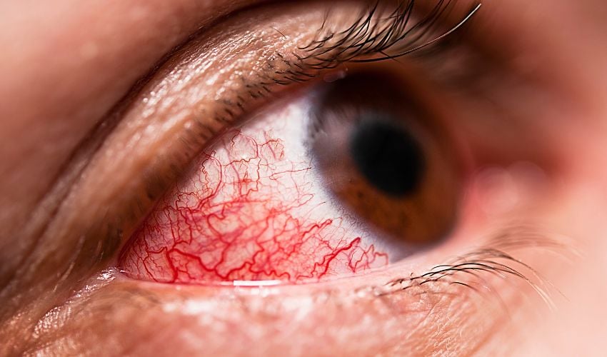 An epidemic of conjunctivitis spread in Mandi Bahauddin.